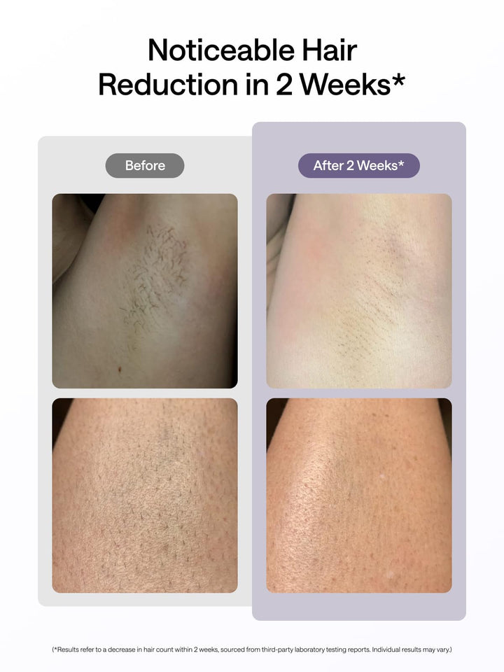 Ulike Air 10 Depiladora IPL UI20DB